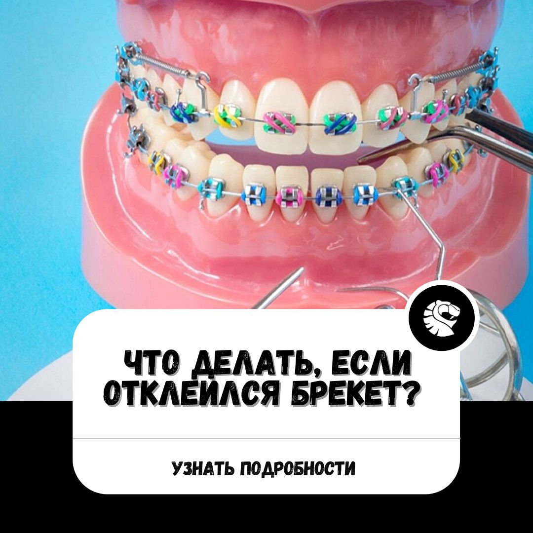 ЧТО ДЕЛАТЬ, ЕСЛИ ОТКЛЕИЛСЯ БРЕКЕТ? - КРАНЭКС стоматологический центр